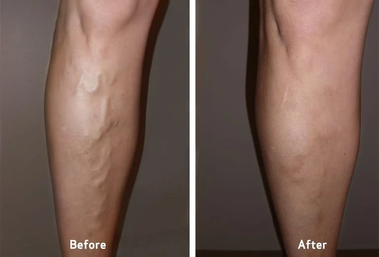 Varicose Veins Legs Treatment Before After Comparison